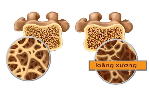 Những tác hại của bệnh loãng xương người bệnh nên biết